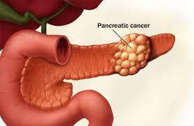 Cancerul pancreatic e… compus din patru cancere diferite!