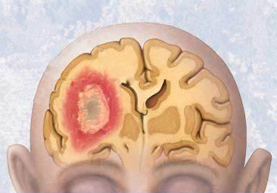 tumori cerebrale vindecarea tumorilor cerebrale