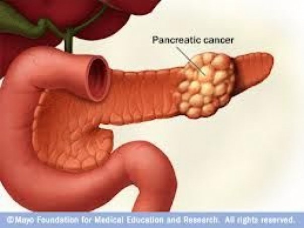 cancerul la pancreas