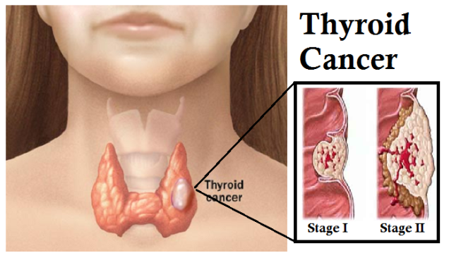 cancerul de tiroidă