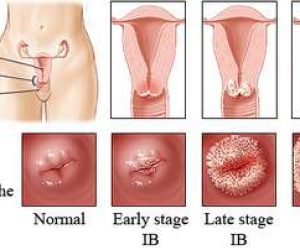 cancerul de col uterin