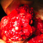 Despre cancerul peritoneal