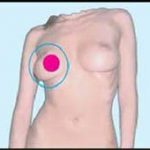 Exemple de tratament cu Su Jok. Cancer mamar.