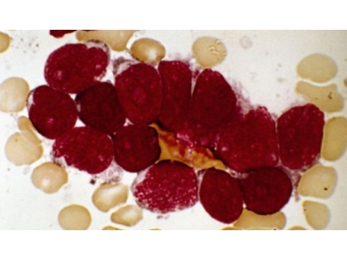 celule rosii, albe, sistemul imunitar, faza terminala de cancer, in faza terminala de cancer